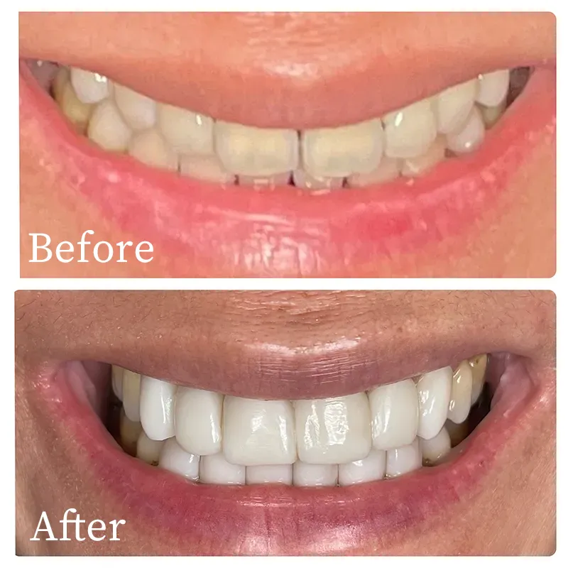 Bioclear before and after patient results - Harmony Family Dentistry in Vancouver WA