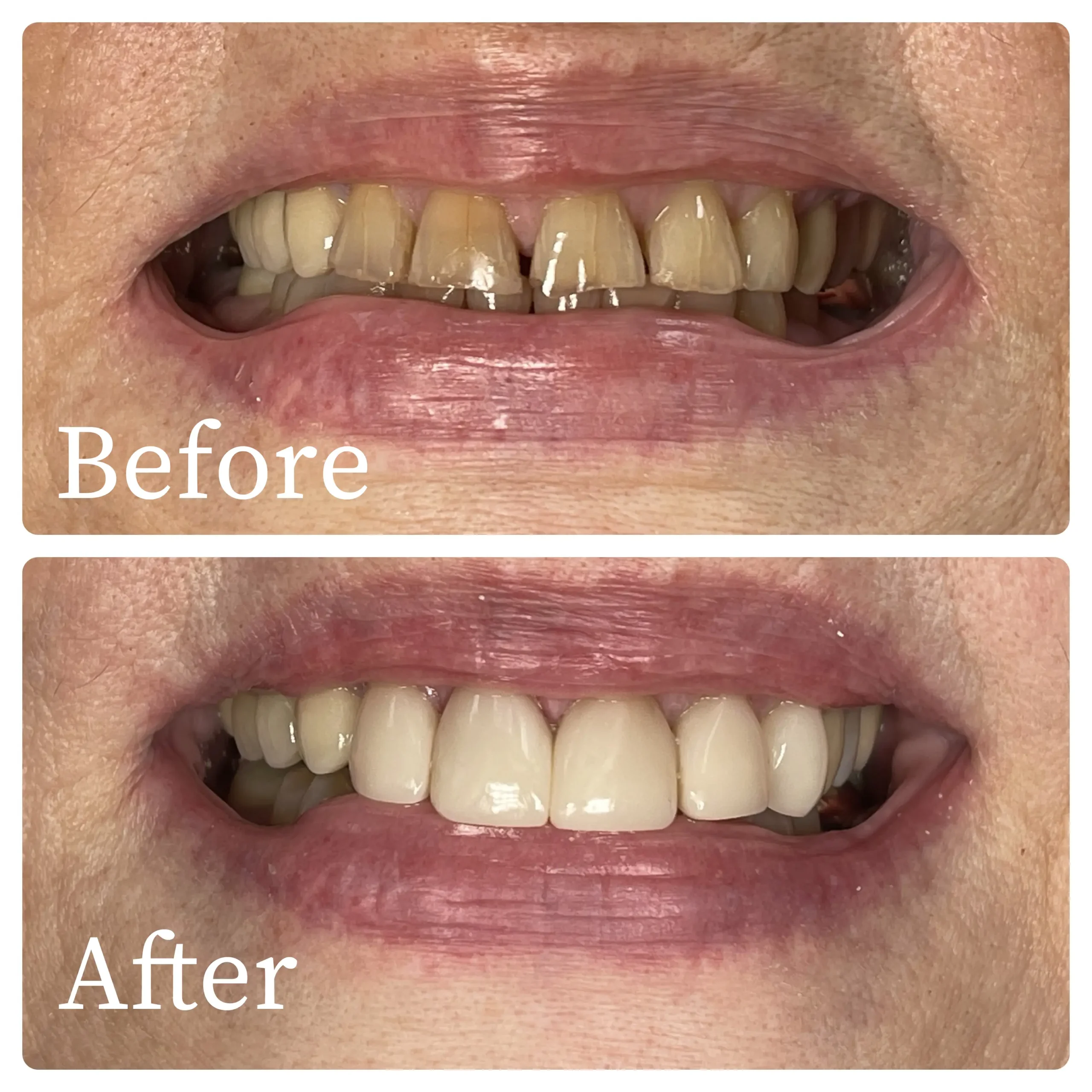 Bioclear before and after results on patient's teeth - Harmony Family Dentistry in Vancouver WA