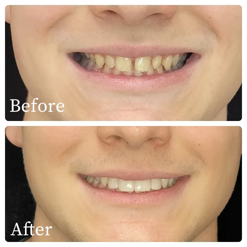 Patient's results before and after bioclear treatment - Harmony Family Dentistry in Vancouver WA