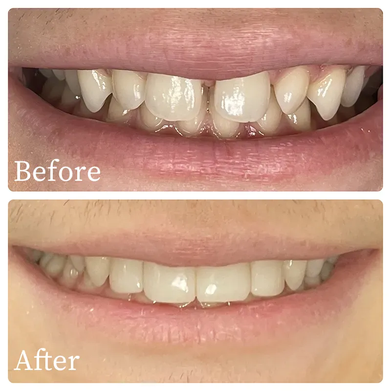 cosmetic before and after results form bioclear treatment - Harmony Family Dentistry in Vancouver WA