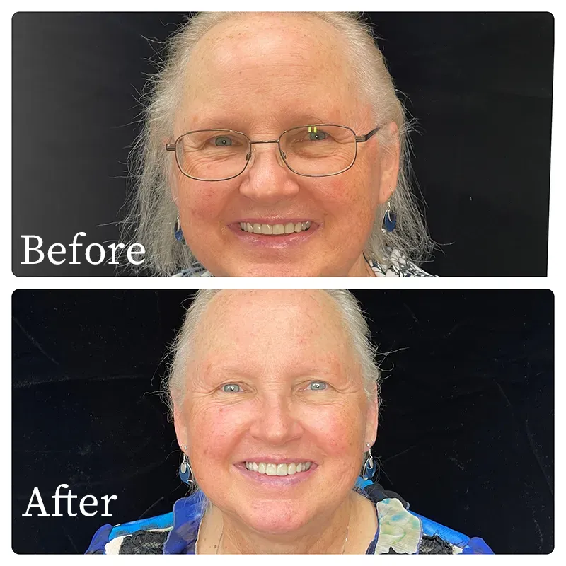 Patient before and after photos of crown replacement - Harmony Family Dentistry in Vancouver WA