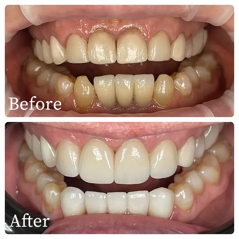 Patients teeth with before and after crown replacement - Harmony Family Dentistry in Vancouver WA