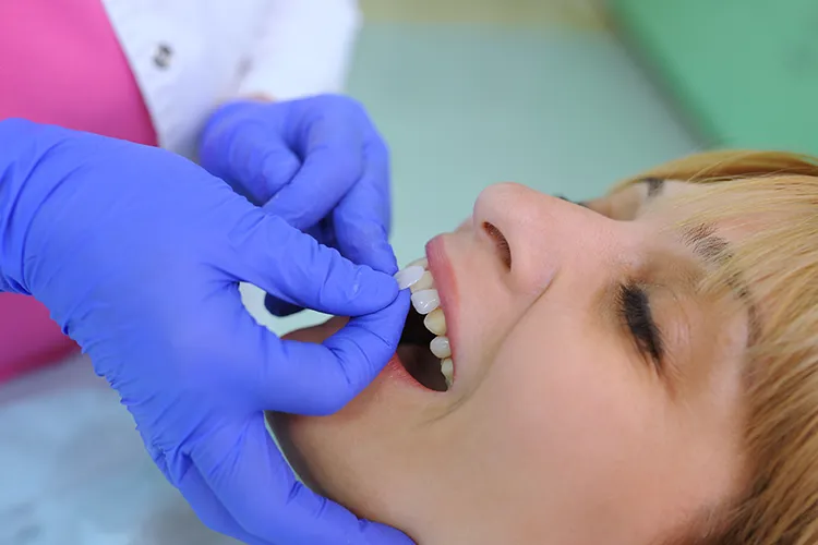 Veneers being placed on a dental patient - Harmony Family Dentistry in Vancouver WA